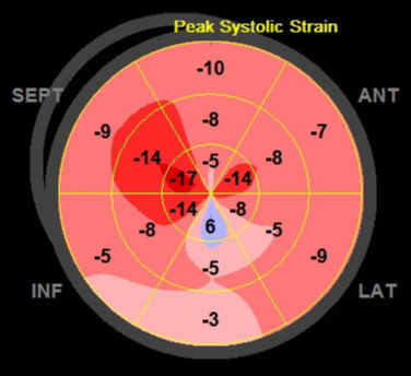 Gls Darstellung Einer Stark Beeintrachtigten Herzmuskel Leistungsfahigkeit Gls Darstellung Einer Abgeheilten Myocarditis Form Einer Diffusen Relativ Starken Herzmuskelentzundung Fast Alle Segmente Sind Befallen Behandlung Zur Entlastung Des